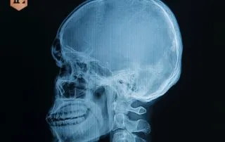 blunt for trauma to head from car accident